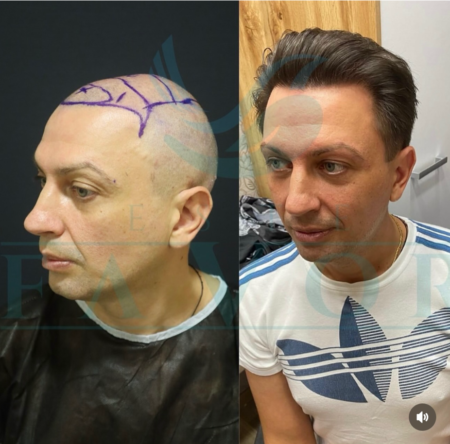 Top 10 des meilleures cliniques de greffe de cheveux en Turquie avec prix